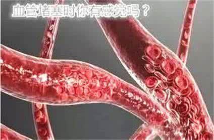 血液淤堵可以吃猪瓜吗,缓解血液淤堵困扰  第3张